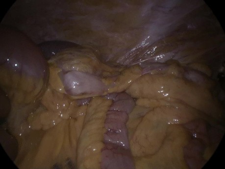 Hernie Interne après Chirurgie Colorectale Laparoscopique