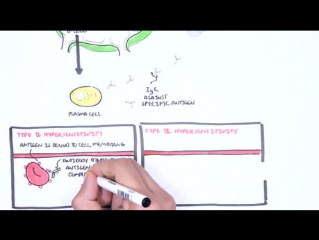 Hypersensibilité de type III (complexes immuns) - causes, physiopathologie