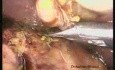 Cholécystectomie laparoscopique à deux incisions