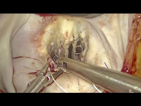 Plastie Endoscopique de la Valve Mitrale dans la Rupture Aigue des Cordages