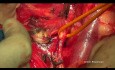 Chirurgie cytoréductive du cancer de l'ovaire. L'hystérectomie d'Hudson.