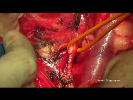 Chirurgie cytoréductive du cancer de l'ovaire. L'hystérectomie d'Hudson.