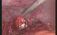 Réparation chirurgicale de hernie inguinale bilatérale avec la pose d'un filet