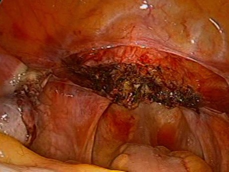 L'hystérectomie supracervicale laparoscopique à l'aide d'un manipulateur utérin