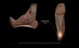 Fracture du Calcanéum : Anatomie, Biomécanique, Considérations Chirurgicales, Démonstration ORIF