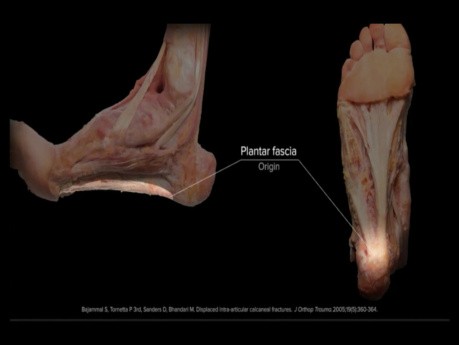 Fracture du Calcanéum : Anatomie, Biomécanique, Considérations Chirurgicales, Démonstration ORIF