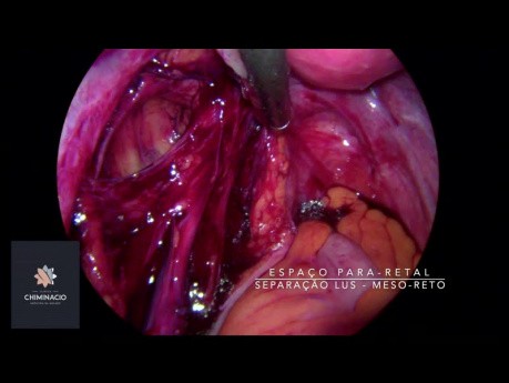 Traitement chirurgical de l'endométriose - une patiente infertile