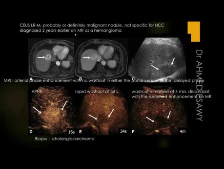 Échographie - hépatopathie diffuse: fibrose, cirrhose, score échographique, fibroscan, hépatite, CSP, HAI, CBP