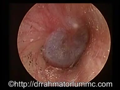 « Oreille collante » - Tympan Pulsatile