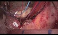 Maladie Carcionïde Tricuscpidienne - Chirurgie Endoscopique