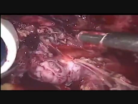 Lésion urétérale - un gros fibrome cervical de 17 × 17 cm