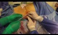 Pontage urétéral sous-cutané pour sténose urétérale complexe