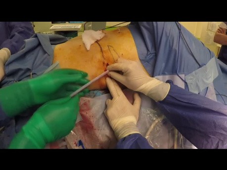 Pontage urétéral sous-cutané pour sténose urétérale complexe