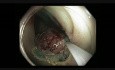 Coloscopie - Rectum - LST tumeur non granulaire - Piece meal EMR