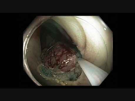 Coloscopie - Rectum - LST tumeur non granulaire - Piece meal EMR