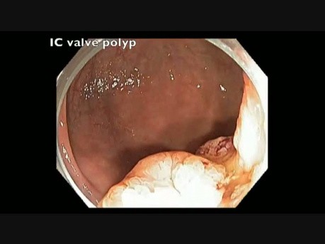 Valvule Iléo-cæcale - Polype - Échec de Résection