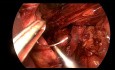 Renforcement du maillage hiatal pour la grande hernie hiatale et la fundoplication de Toupet