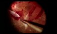 Viscodissection pour la rétinopathie diabétique proliférative fibrotique traction