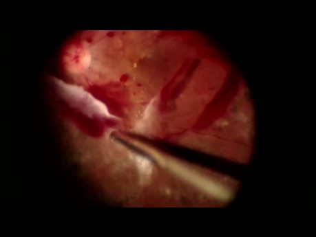 Viscodissection pour la rétinopathie diabétique proliférative fibrotique traction