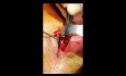 Fracture du plancher orbital du type blow-out ; Approche rétroseptale transconjonctivale