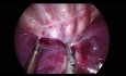 Lobectomie inférieure droite par chirurgie thoracique vidéo-assistée (CTVA) à l'incision unique chez un enfant de 1 an en raison d'une maladie adénomatoïde kystique du poumon