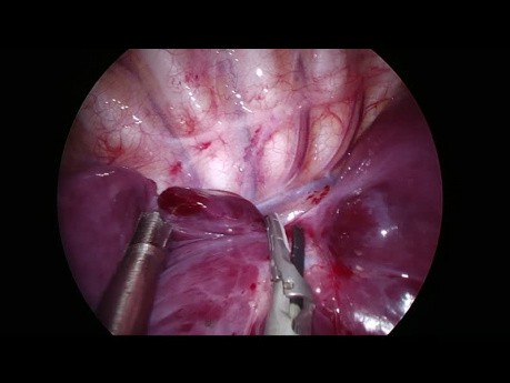 Lobectomie inférieure droite par chirurgie thoracique vidéo-assistée (CTVA) à l'incision unique chez un enfant de 1 an en raison d'une maladie adénomatoïde kystique du poumon