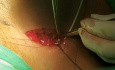 Comment je pose une chambre implantable par technique de dénudation de la veine céphalique
