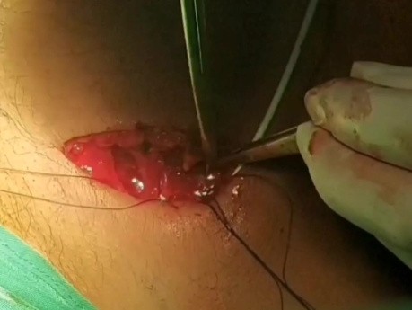 Comment je pose une chambre implantable par technique de dénudation de la veine céphalique