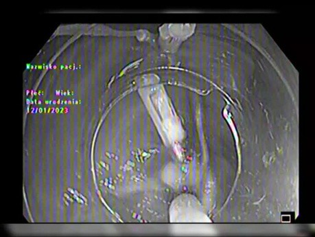 ESD par Clip et Fil