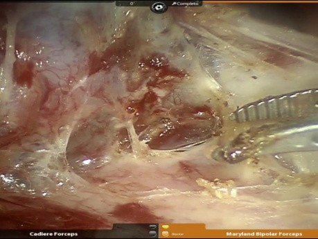 Tumeur carcinoïde bronchique du tronc intermédiaire 