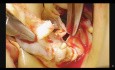 Chirurgie de Bentall Mini-Invasive