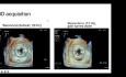 Introduction à l'Echocardiographie 3D - Partie 1 : Acquisition et Traitement des Images