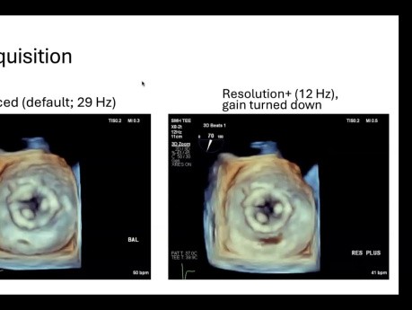 Introduction à l'Echocardiographie 3D - Partie 1 : Acquisition et Traitement des Images