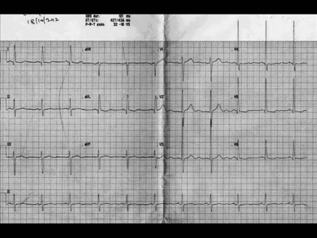  Quiz 1 de Cardiologie - l'échocardiographie. Un patient avec un souffle cardiaque - ECG, écho et traitement
