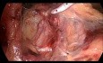 Proctocolectomie totale avec iléostomie terminale par laparoscopie