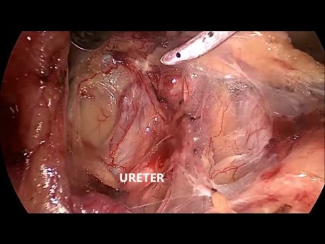 Proctocolectomie totale avec iléostomie terminale par laparoscopie