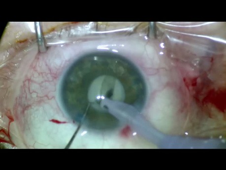Cataracte hypermature blanche + élève de 3,5 mm + PEX
