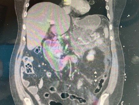 Cystgastrostomie avec le stent