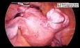 Myomectomie par laparoscopie pour l'ablation d'un gros fibrome de ligament large
