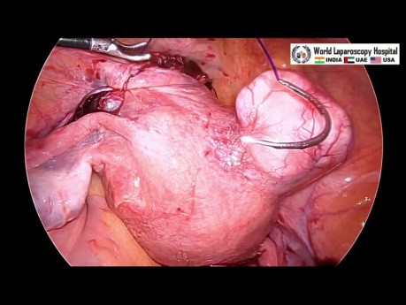 Myomectomie par laparoscopie pour l'ablation d'un gros fibrome de ligament large