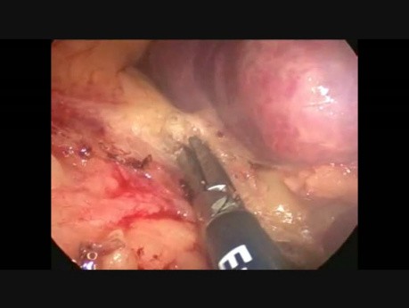 Splénectomie laparoscopique pour les abcès spléniques multiples
