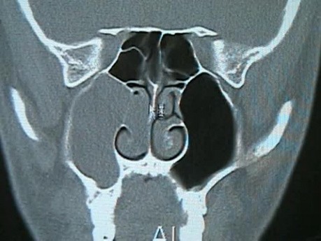 Polype Choanal - ablation endoscopique