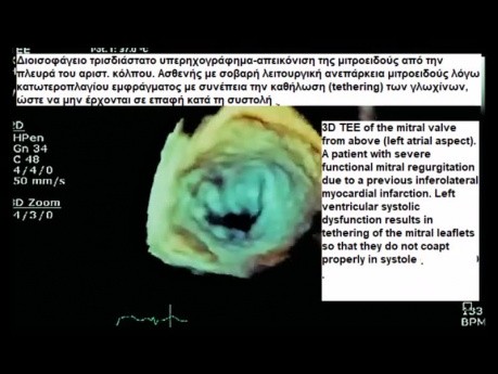 Insuffisance mitrale fonctionnelle: échocardiographie transœsophagienne 2D et 3D