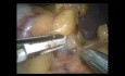 Splénectomie par voie laparoscopique en raison des anévrismes multiples de l'artère splénique