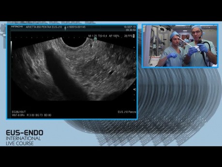 Échographie endoscopique (EUS) avec biopsie à l'aiguille fine (BAF)