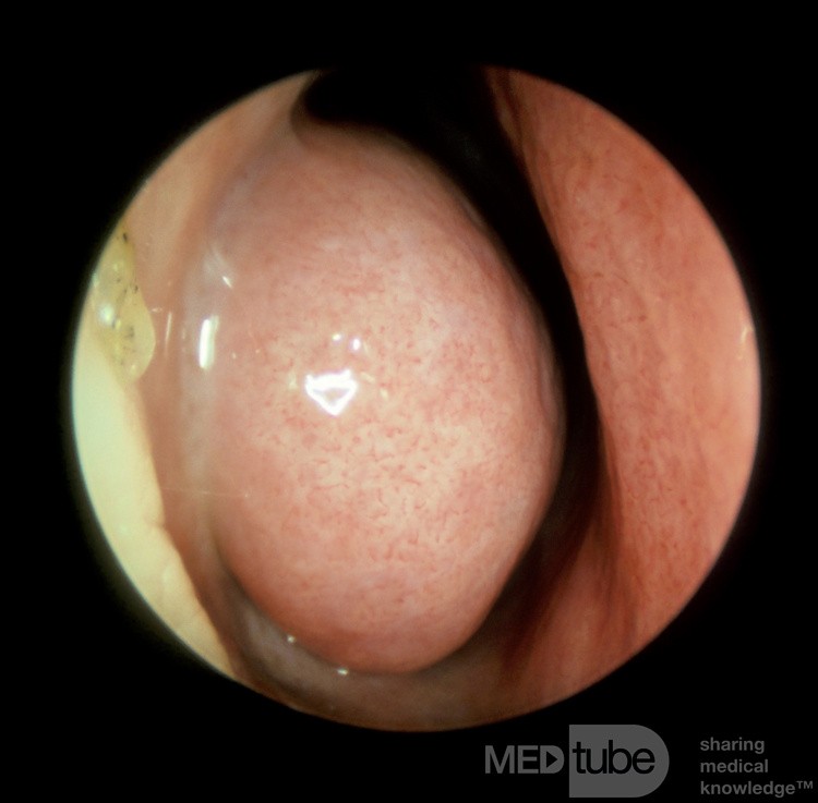 Turbinate inférieur enflé [vasodilaté] [gauche]