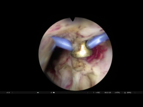 Énucléation endoscopique bipolaire par vaporisation de la prostate