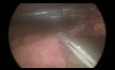 Perforation de l'Intestin Grêle par Traumatisme Abdominal - Approche laparoscopique