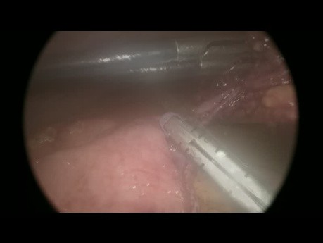 Perforation de l'Intestin Grêle par Traumatisme Abdominal - Approche laparoscopique