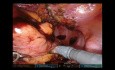 Résection Robotisée du Sigmoïde T4 avec Résection de la Vessie et de l'Intestin Grêle en Bloc